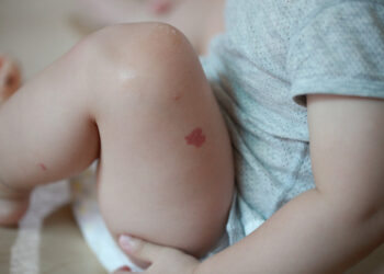 Odos braškinis hemangiomas