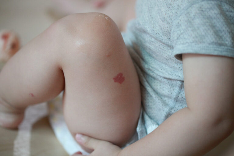 Odos braškinis hemangiomas
