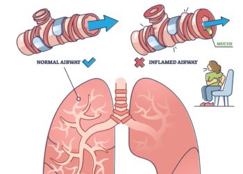 Patarimai, kaip stebėti stiprios astmos sukėlėjus
