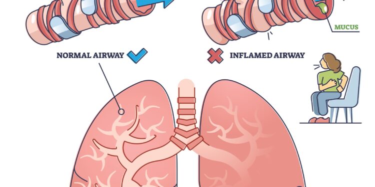 Patarimai, kaip stebėti stiprios astmos sukėlėjus