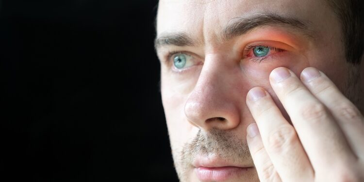 Kas yra medžiaginis (arba lininis) konjunktyvitas?