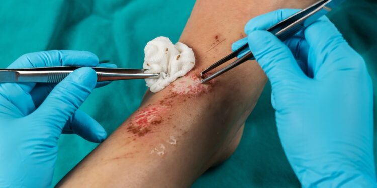 Svarbiausia, ką reikia žinoti apie žaizdos valymą