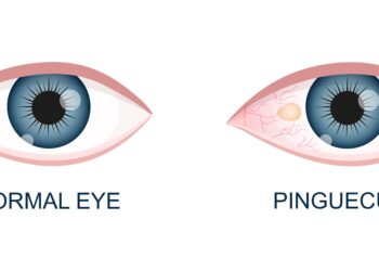 Kodėl man ašaroja akys?