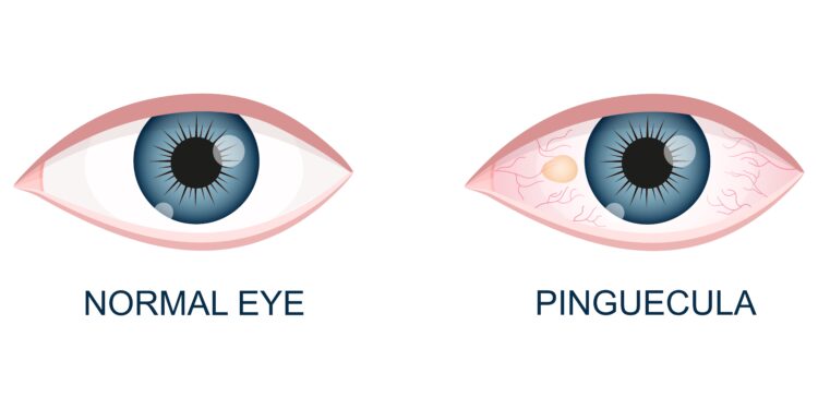 Kodėl man ašaroja akys?