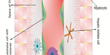 IV stadijos šlapimo pūslės vėžys: prognozė ir gyvenimo trukmė
