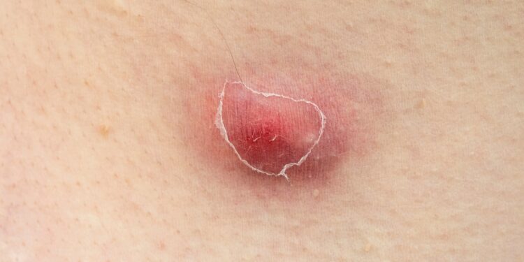 Kodėl man po pažastimis atsiranda pūliniai?