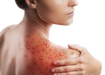 Ar stafilokokinė infekcija gali sukelti gerklės skausmą?