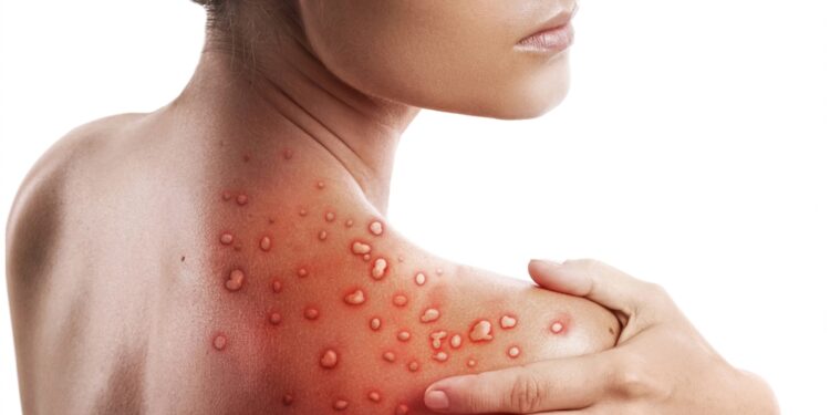 Ar stafilokokinė infekcija gali sukelti gerklės skausmą?