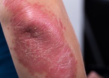 Gyvenimas su nematoma liga: kaip jaučiasi sergantieji psoriaziniu artritu