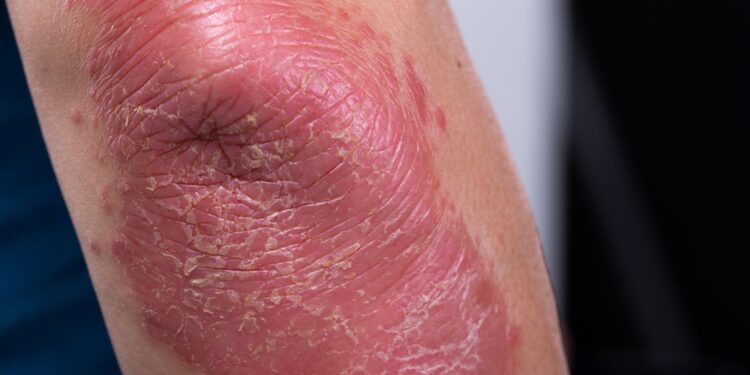 Gyvenimas su nematoma liga: kaip jaučiasi sergantieji psoriaziniu artritu