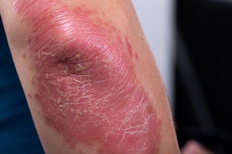 Gyvenimas su nematoma liga: kaip jaučiasi sergantieji psoriaziniu artritu
