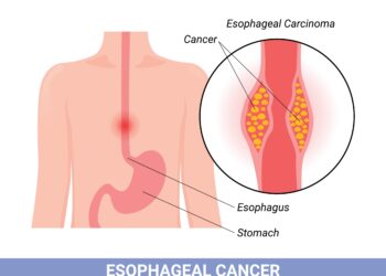 Kokie tulžies pūslės vėžio simptomai moterims?