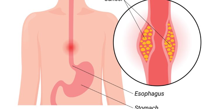 Kokie tulžies pūslės vėžio simptomai moterims?