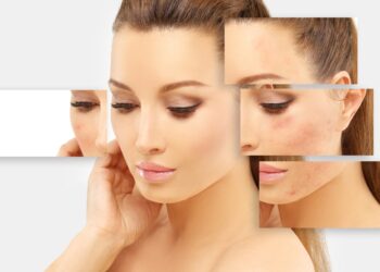 Kaip pašalinti spuogų šašus