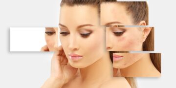 Kaip pašalinti spuogų šašus