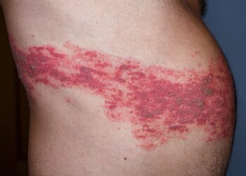 Nubliuškusių (arba Nuplikytos) odos sindromas