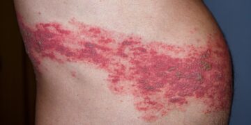 Nubliuškusių (arba Nuplikytos) odos sindromas