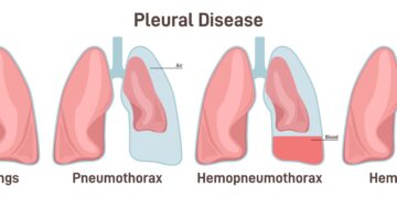 Kas yra vandenilio kvėpavimo testas?
