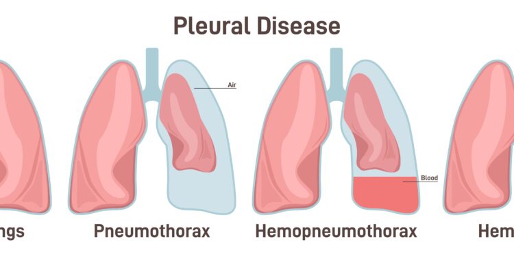 Kas yra vandenilio kvėpavimo testas?
