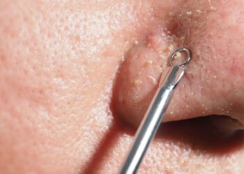 Kas tas raudonas taškelis ant mano nosies?