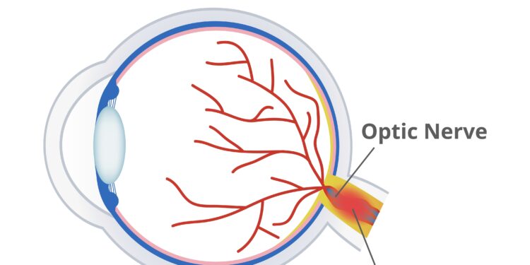 Markuso Gunno vyzdys (santykinis aferentinis vyzdžio defektas)