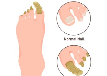 Viskas, ką reikia žinoti apie duobėtąją keratolizę