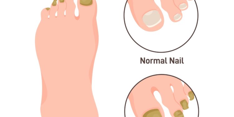 Viskas, ką reikia žinoti apie duobėtąją keratolizę