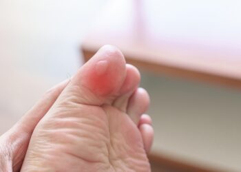 Pūslės ant pėdų: svarbiausia informacija