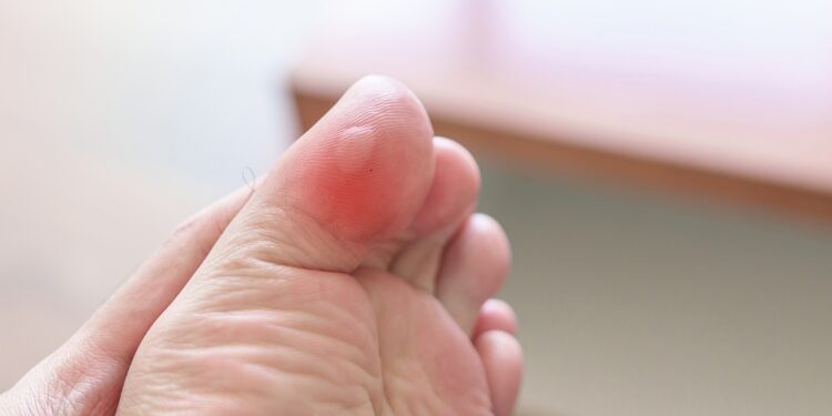 Pūslės ant pėdų: svarbiausia informacija