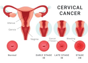 Ar gali paauglės susirgti kiaušidžių vėžiu?