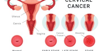 Ar gali paauglės susirgti kiaušidžių vėžiu?