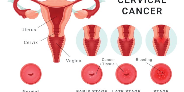 Ar gali paauglės susirgti kiaušidžių vėžiu?