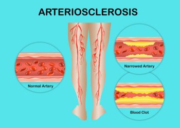 Kaulų tuberkuliozė
