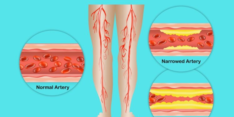 Kaulų tuberkuliozė
