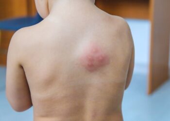 Mielinė infekcija ar vystyklų bėrimas mažiems vaikams: kaip atskirti?