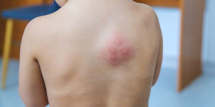 Mielinė infekcija ar vystyklų bėrimas mažiems vaikams: kaip atskirti?