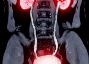 8 dalykai, kuriuos verta nuveikti per inkstų vėžio žinomumo mėnesį