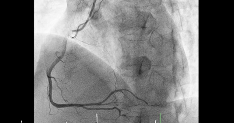 Širdies kraujagyslių angiografija
