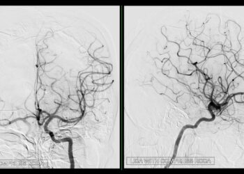 Fluoresceino angiografija