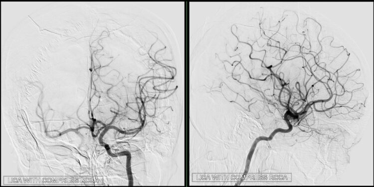 Fluoresceino angiografija