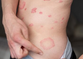 Keturi kartai, kai neleisdavau psoriazei valdyti savo gyvenimo