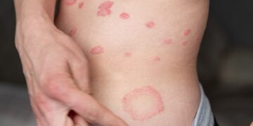 Keturi kartai, kai neleisdavau psoriazei valdyti savo gyvenimo