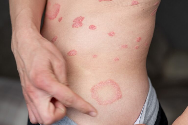 Keturi kartai, kai neleisdavau psoriazei valdyti savo gyvenimo