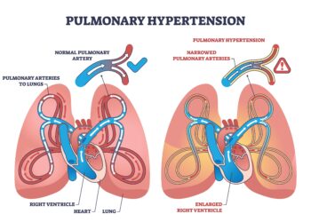 Koks iš tikrųjų yra gyvenimas su IPF
