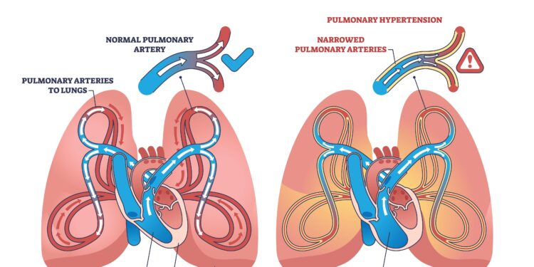 Koks iš tikrųjų yra gyvenimas su IPF