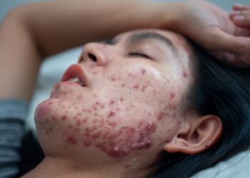 Veido grybelinės (mielių) infekcijos: priežastys ir gydymas