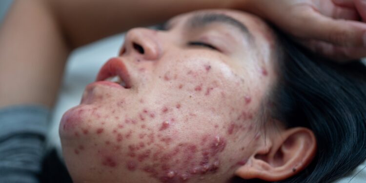 Veido grybelinės (mielių) infekcijos: priežastys ir gydymas