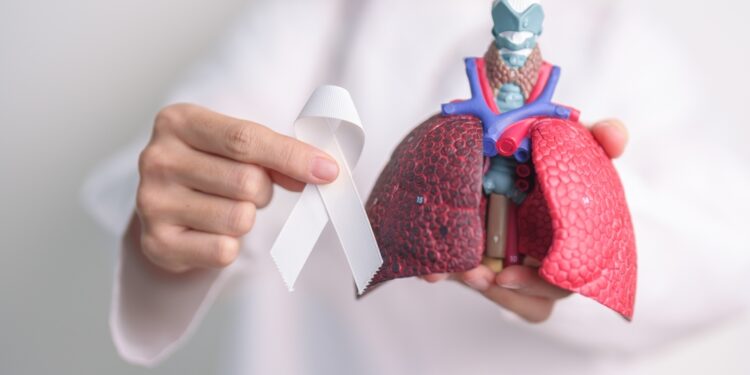 Kas yra antros stadijos plaučių vėžys?