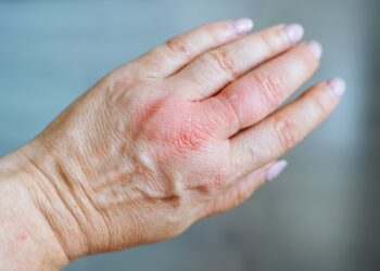 Patinusios rankos rytais