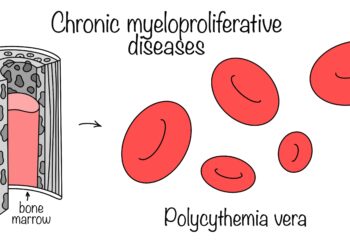 Policitemija vera: prognozė ir gyvenimo trukmė